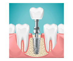 Average Cost of Dental Implants: Pricing & Factors