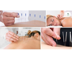 Best Acupuncture Therapy Near Me for Natural Pain Relief