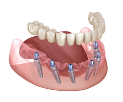 Best Full Mouth Dental Implant Surgeon: Restore Your Smile with Expert Precision